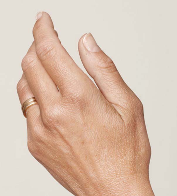 A lady's hand before having injections of Restylane treatment