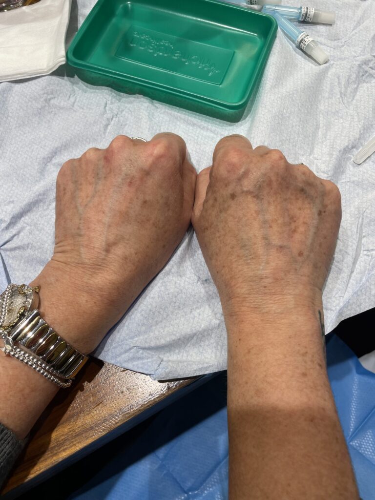 hand rejuvenation treatment before and after