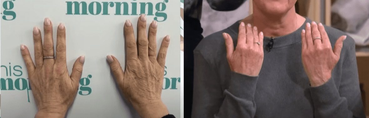 hand rejuvenation treatment before and after - hand transformation