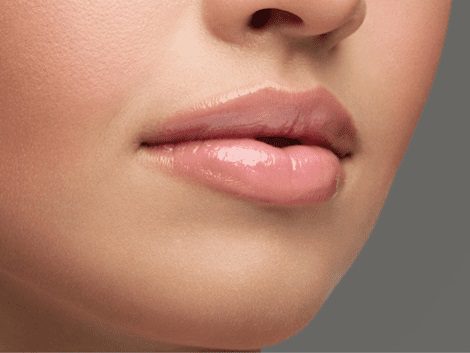 how long do lip fillers last, lip filler results duration