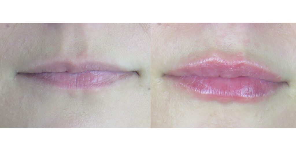 hyaluronic acid fillers lip fillers before and after