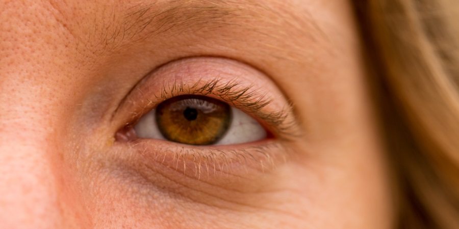 under-eye-wrinkles