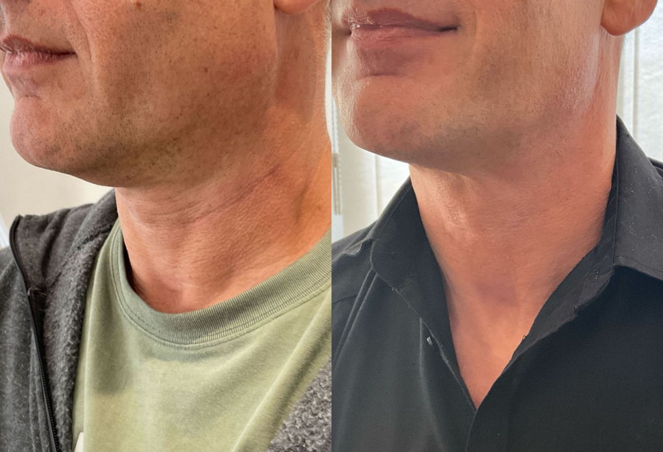 Sculptra before and after
