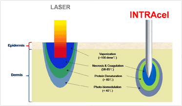 intracel-diagram