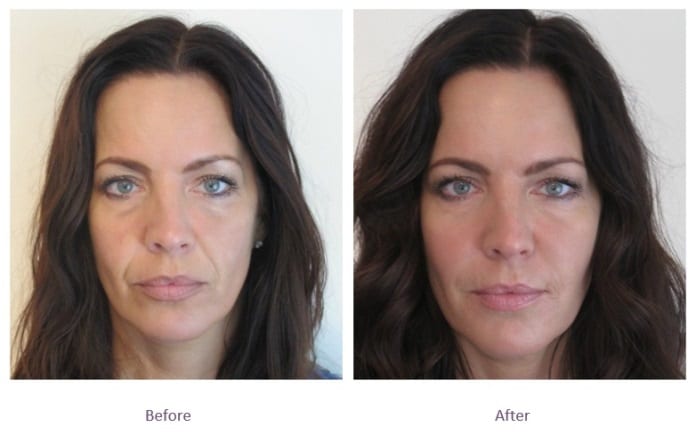 Jawline contouring filler before and after