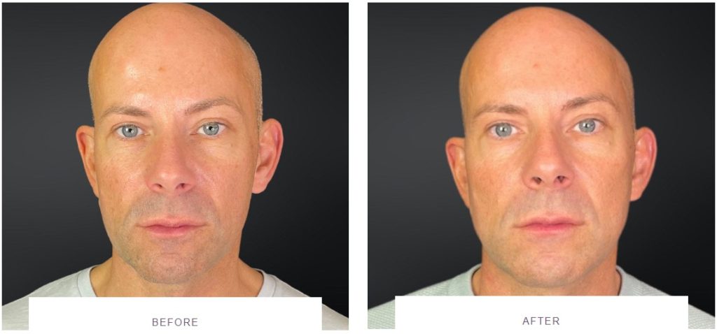 jawline filler before and after male