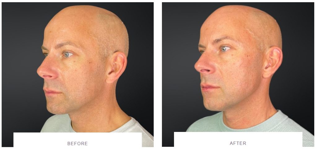 jawline filler male before and after