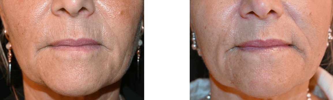 julaine barcode lines, mouth wrinkles, nose to mouth lines