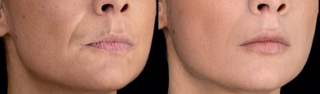 julaine collagen bio activator - before and after results