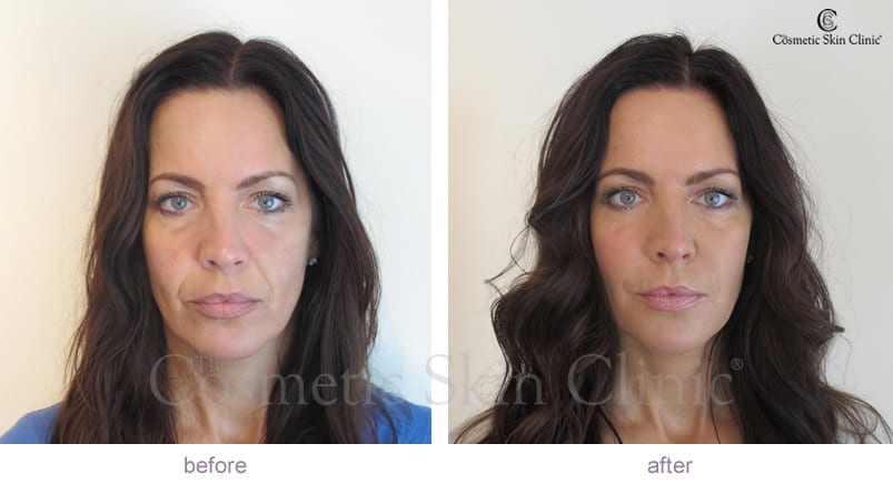 Juvederm before and after