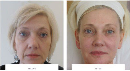 juvederm filler face rejuvenation before after