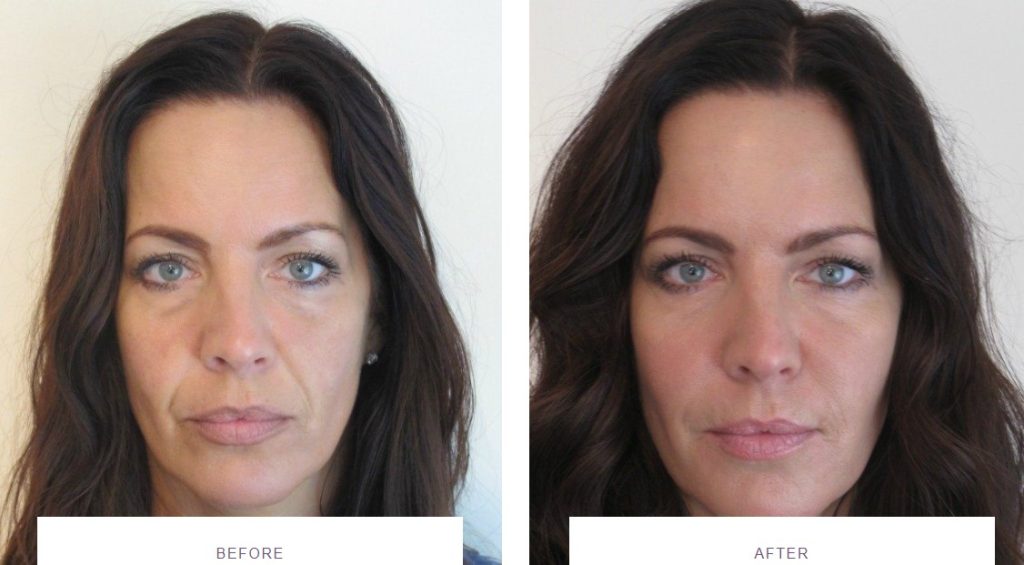 juvederm filler before and after face rejuvenation