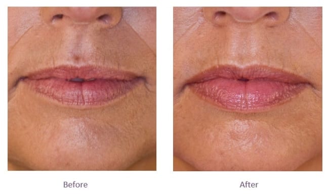 Juvederm lip fillers before and after Juvederm Volbella Lip Filler Before and After