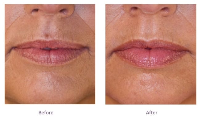 Juvederm Volbella Lip Filler Before and After