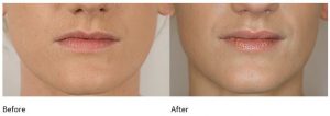 Lip fillers