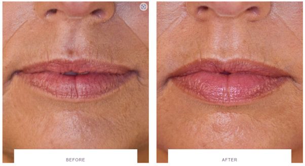 juvederm volbella lip filler before and after