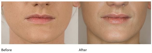 Juvederm Volbella Lip Fillers