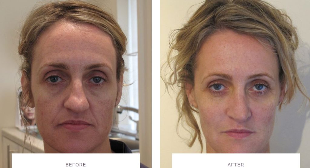 juvederm vycross before and after