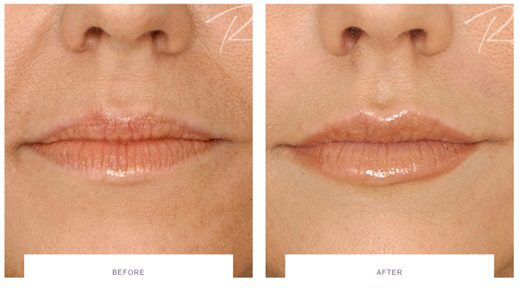 lip enhancement with restylane fillers before and after