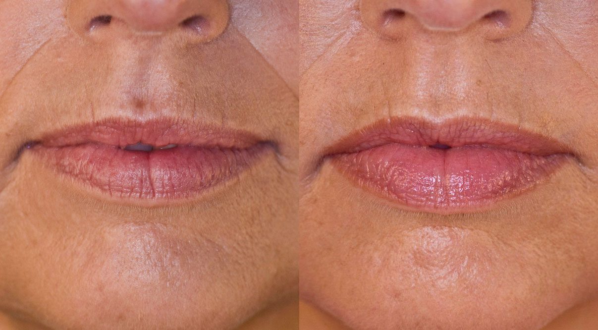 lip filler before and after