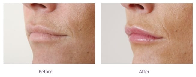 Lip Filler Top Lip Before and After