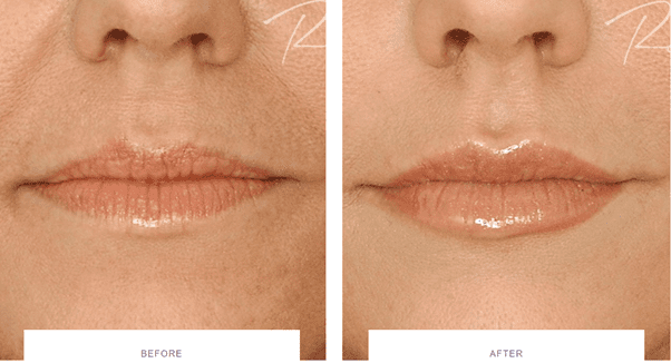 lip enhancement before and after