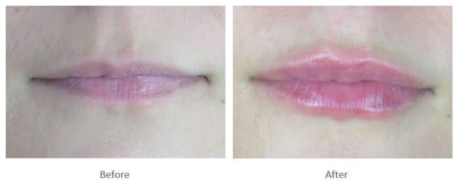 Lip Fillers Before and After Thin Lips