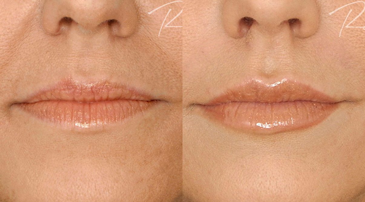lip fillers restylane before and after