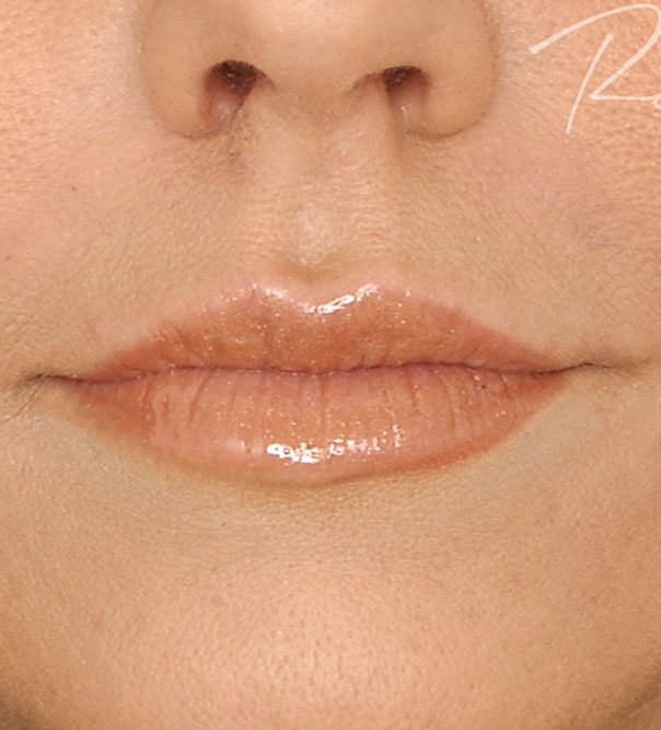 Full and redefined lips following lip filler treatment