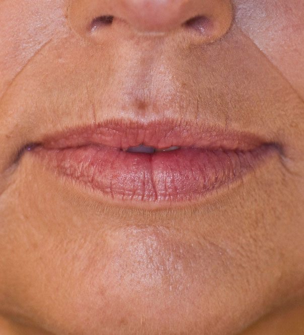 A close up of thin lips before having lip filler treatment