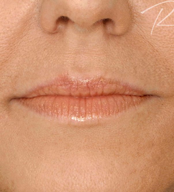 A close up of lips from the front before having lip filler treatment