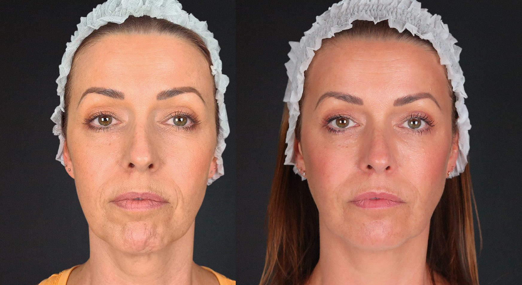 dermal fillers nose to mouth lines, chin dents before and after