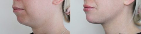 lower face dermal fillers - chin fillers - downturned mouth corners before and after