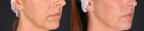 lower face fillers jawline nose-to-mouth lines before and after
