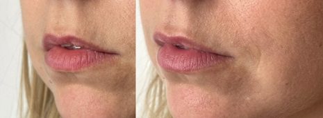 lower face fillers lip lines before and after