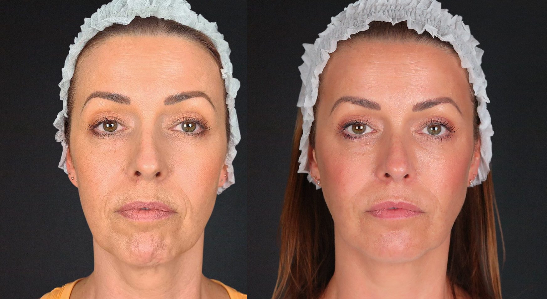 lower facelift before and after by Dr Johanna Ward