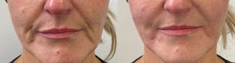 lower facelift with fillers - marionette lines, nasolabial folds before and after