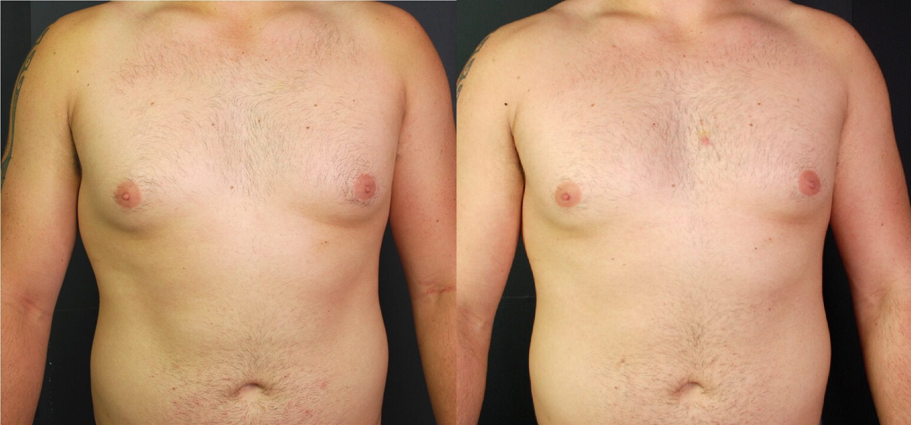 male chest reduction coolsculpting fat freezing before and after