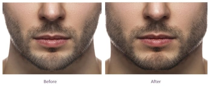 male-jawline-fillers-before-and-after