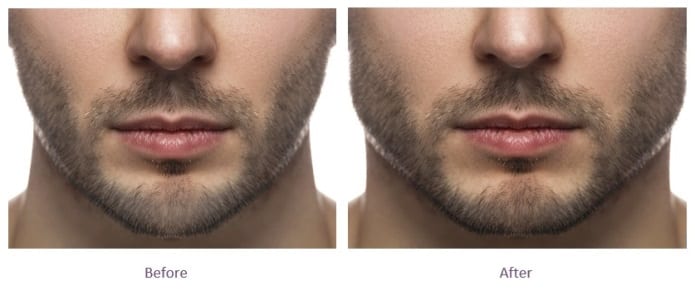mens jawline fillers before and after male-jawline-fillers-before-and-after