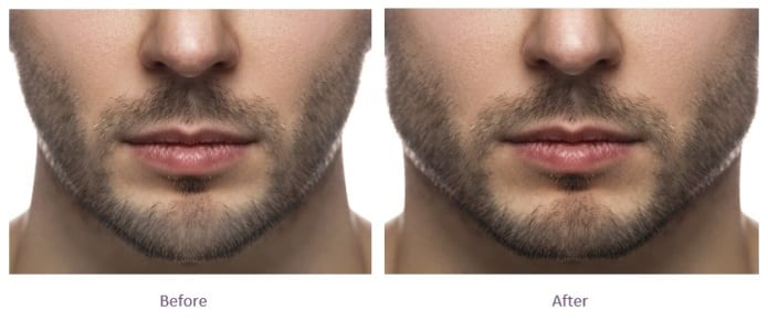 Chiseled Jaw Before And After