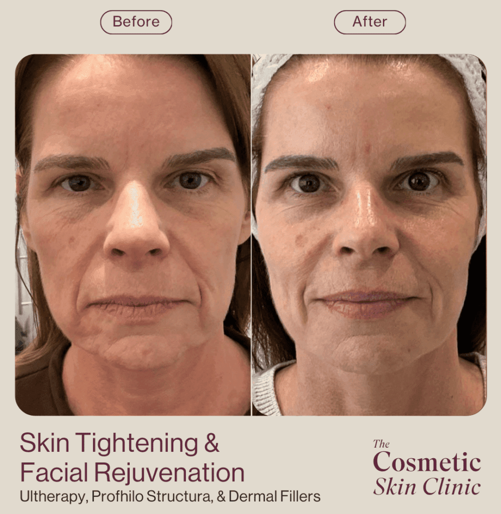 medicated weight loss - skin tightening ultherapy, profhilo, dermal fillers before and after