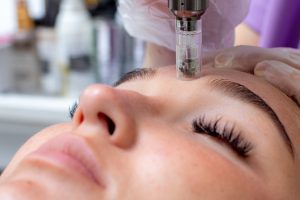 microneedling treatment to book this winter