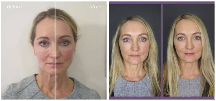 Mid Face Lift with Dermal Fillers before and after