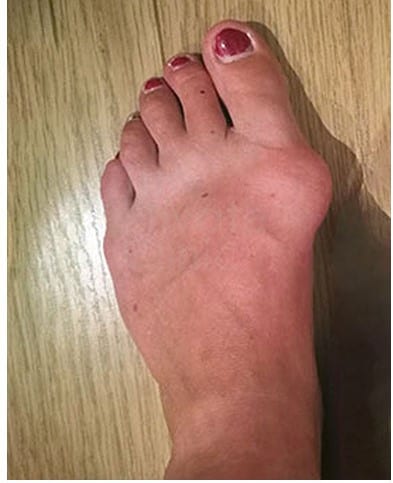 Bunions Treatment - Keyhole Surgery - Before