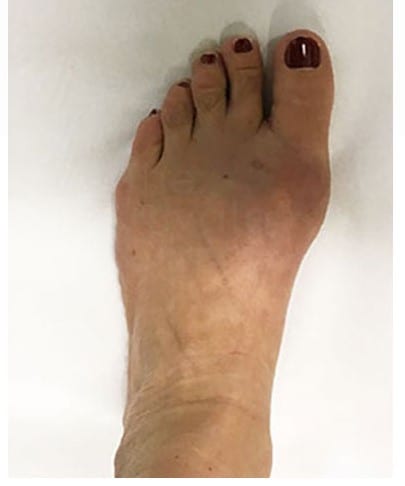 Bunions Treatment - Keyhole Surgery - After