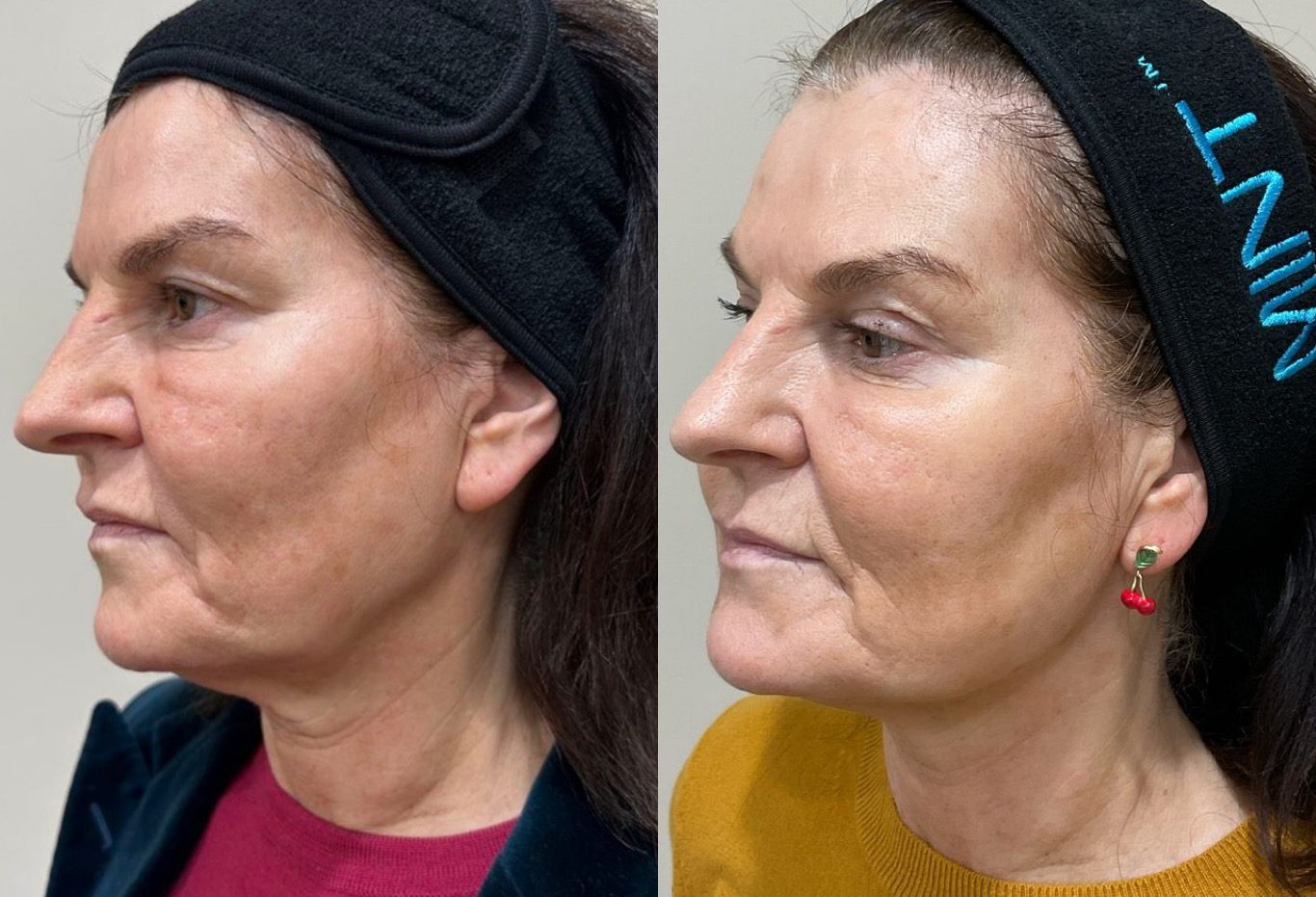 mint pdo thread lift before and after