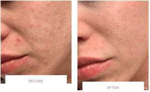 morpheus8 acne before and after