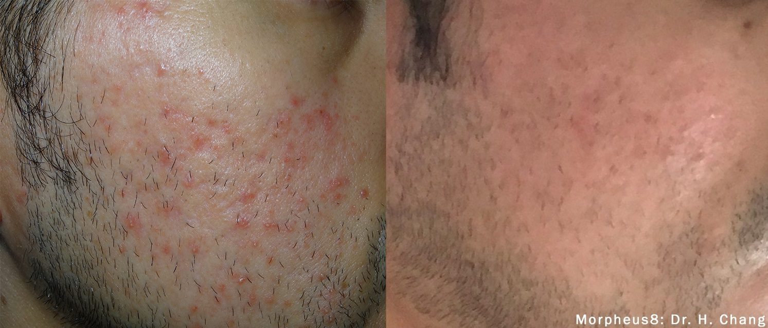 morpheus8 acne male before and after