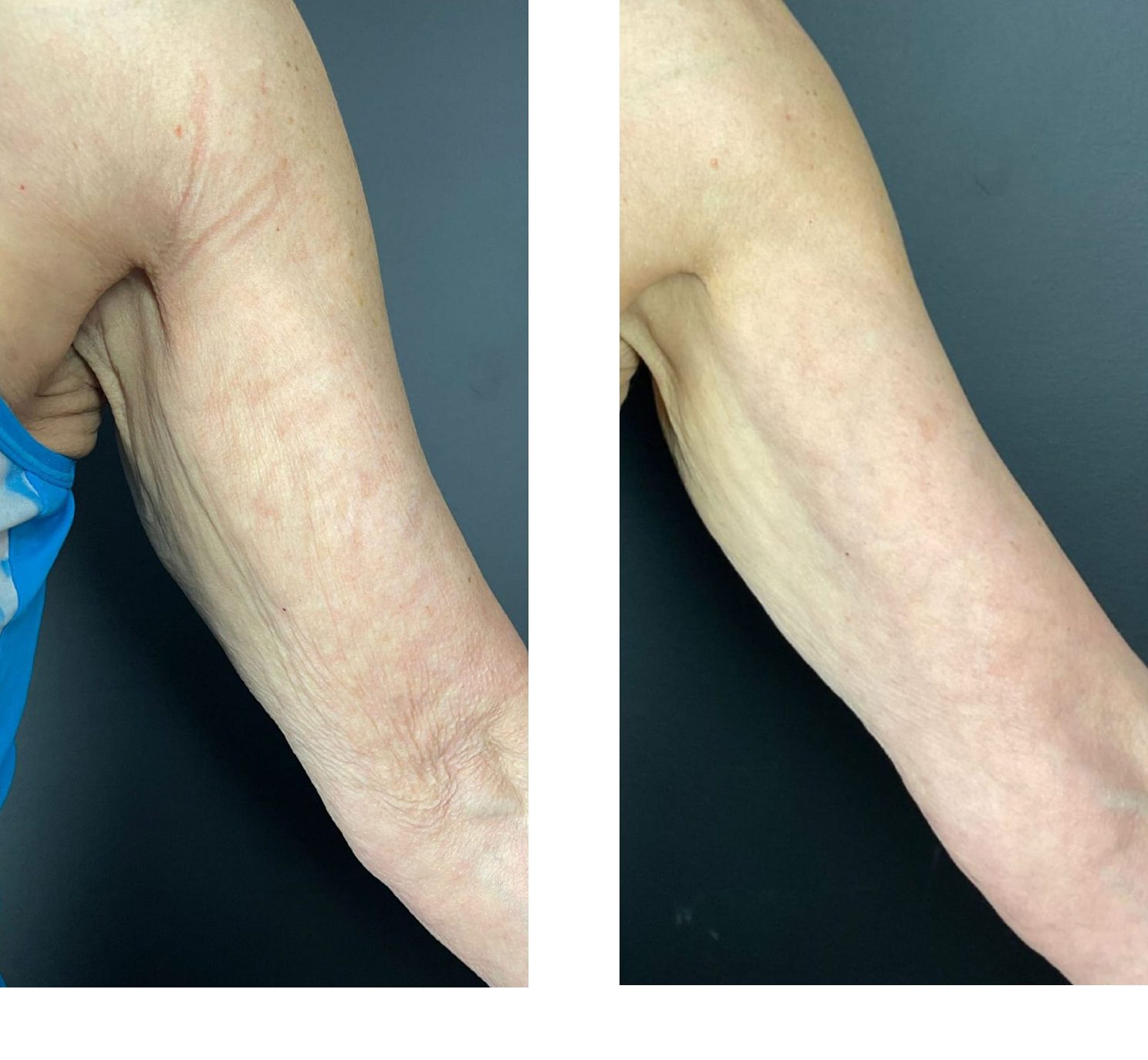 morpheus8 arm profhilo arm before and after